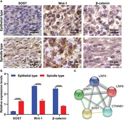 Sclerostin Suppression Facilitates Uveal Melanoma Progression Through Activating Wnt/β-Catenin Signaling Via Binding to Membrane Receptors LRP5/LRP6